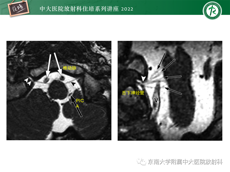 影像PPT - 【PPT】颅神经成像及常见病变-56