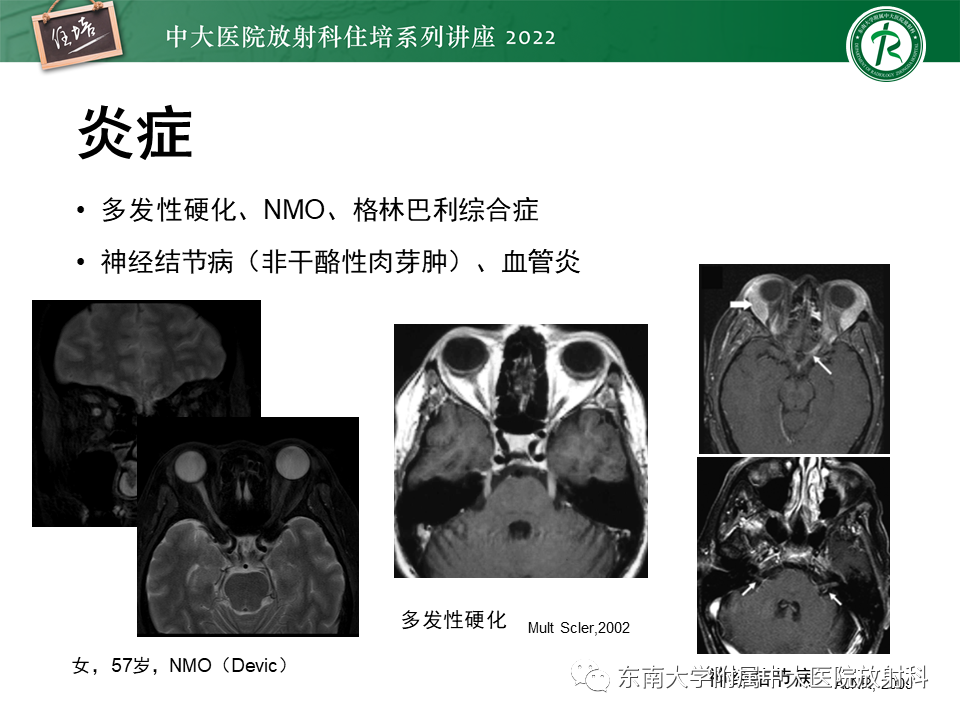 影像PPT - 【PPT】颅神经成像及常见病变-63
