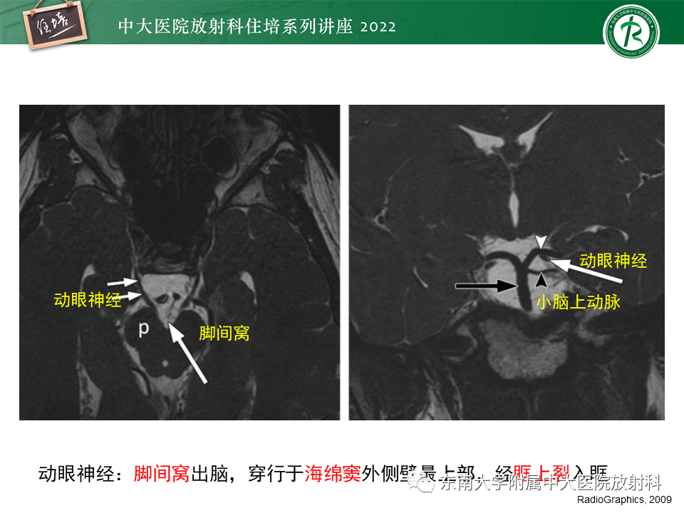 影像PPT - 【PPT】颅神经成像及常见病变-5