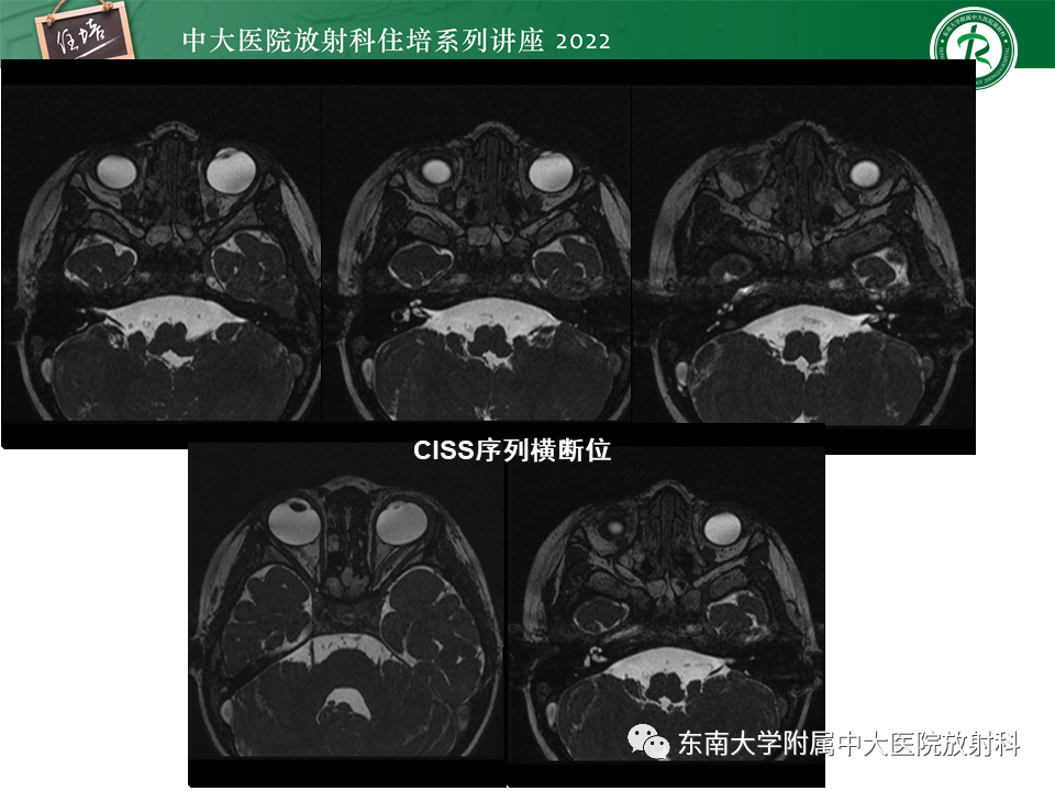 影像PPT - 【PPT】颅神经成像及常见病变-6