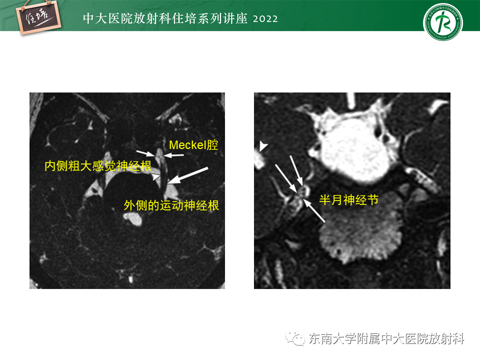 影像PPT - 【PPT】颅神经成像及常见病变-8