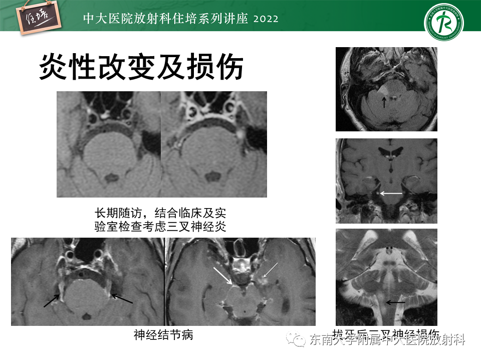 影像PPT - 【PPT】颅神经成像及常见病变-9