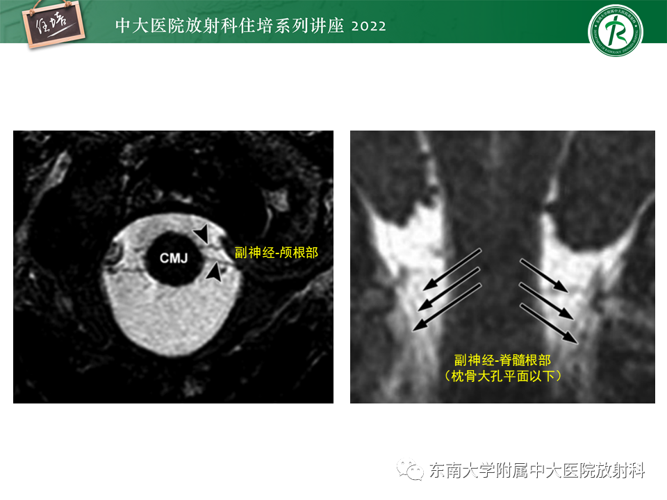 影像PPT - 【PPT】颅神经成像及常见病变-10