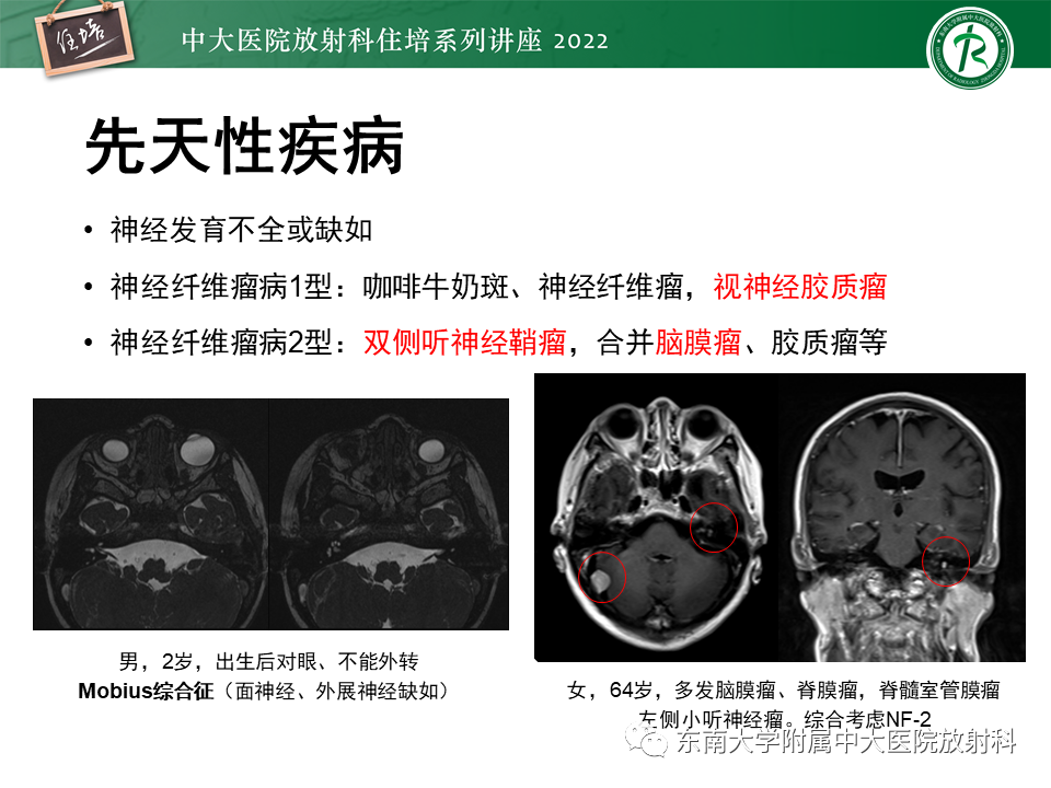 影像PPT - 【PPT】颅神经成像及常见病变-12