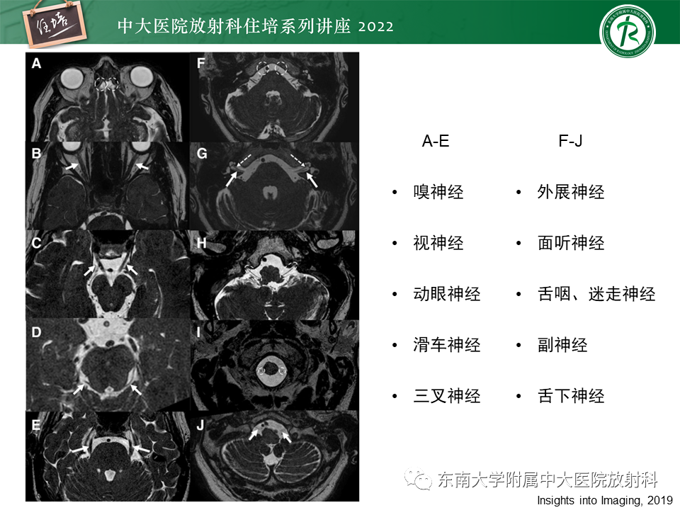 影像PPT - 【PPT】颅神经成像及常见病变-11