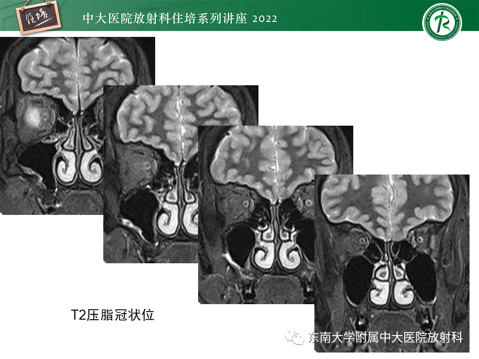 影像PPT - 【PPT】颅神经成像及常见病变-1