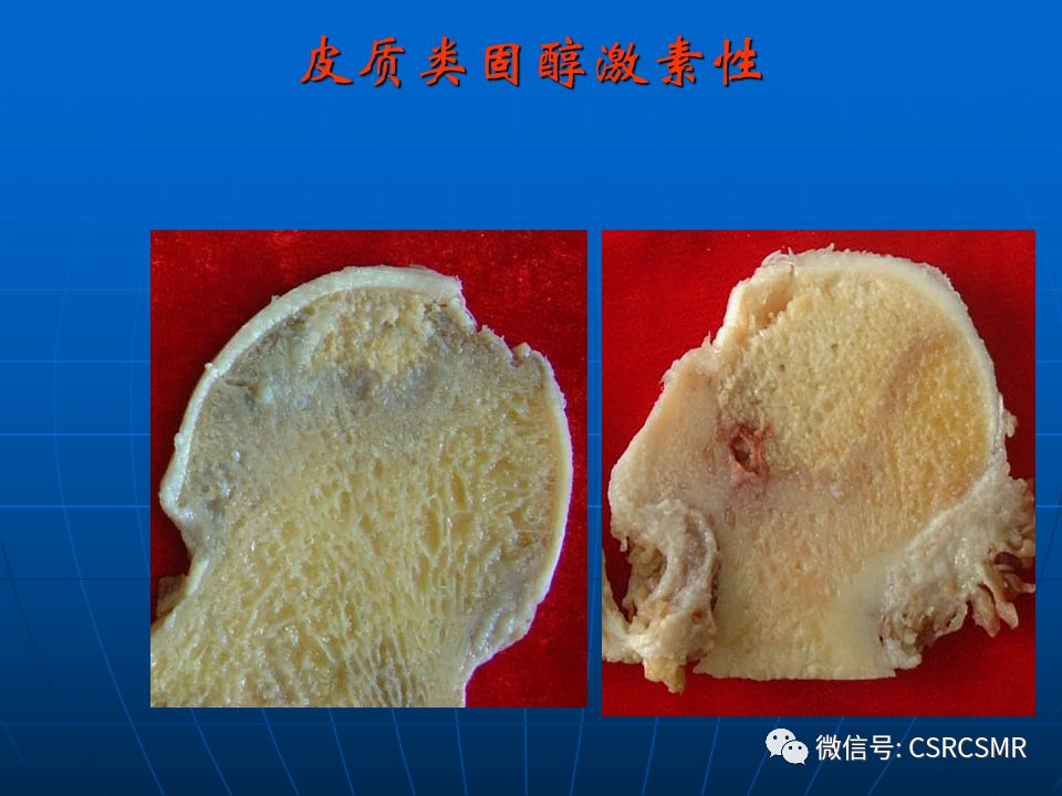 影像PPT - 【PPT】股骨头缺血坏死的大体标本、影像及病理-9