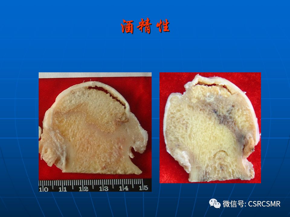 影像PPT - 【PPT】股骨头缺血坏死的大体标本、影像及病理-10