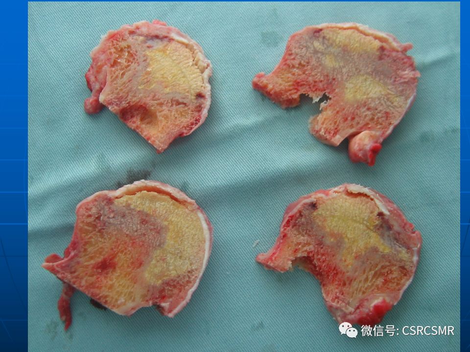 影像PPT - 【PPT】股骨头缺血坏死的大体标本、影像及病理-8