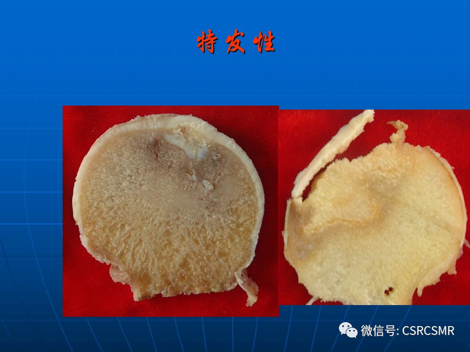 影像PPT - 【PPT】股骨头缺血坏死的大体标本、影像及病理-11