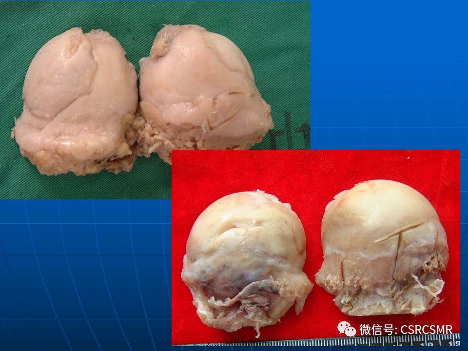 影像PPT - 【PPT】股骨头缺血坏死的大体标本、影像及病理-13