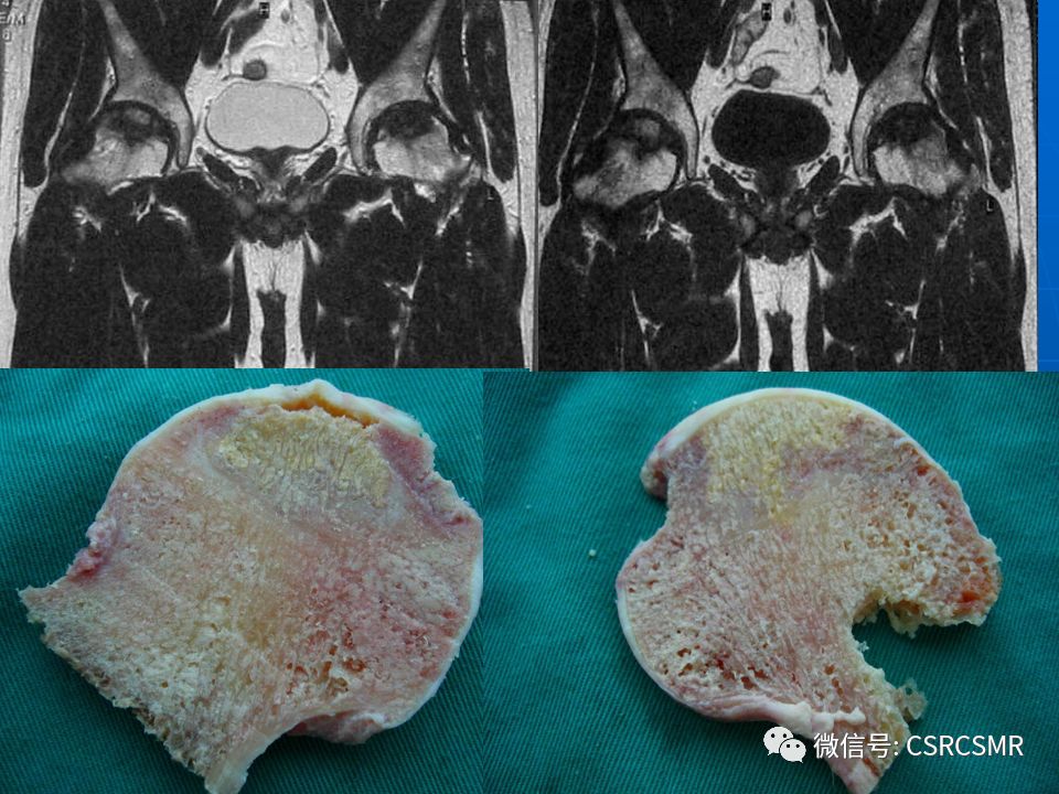 影像PPT - 【PPT】股骨头缺血坏死的大体标本、影像及病理-23