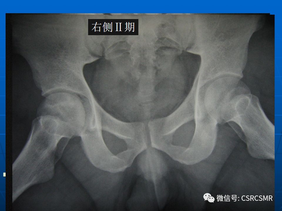 影像PPT - 【PPT】股骨头缺血坏死的大体标本、影像及病理-28