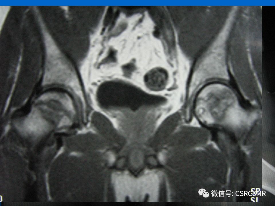 影像PPT - 【PPT】股骨头缺血坏死的大体标本、影像及病理-29