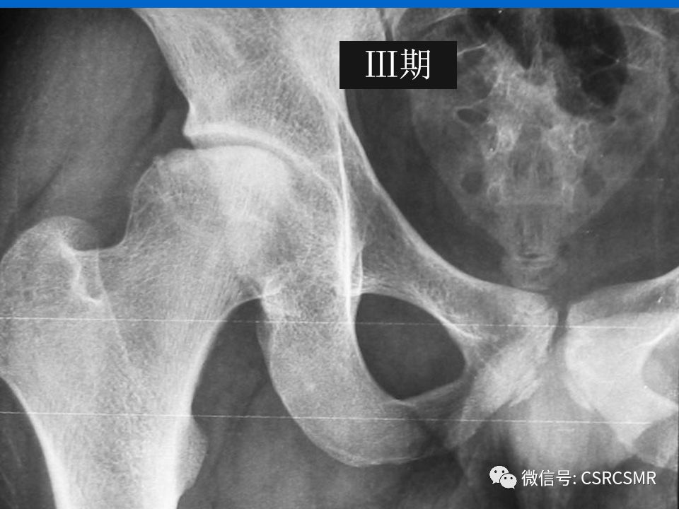 影像PPT - 【PPT】股骨头缺血坏死的大体标本、影像及病理-30