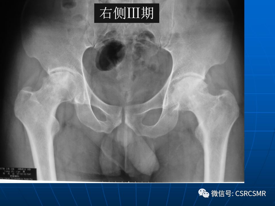 影像PPT - 【PPT】股骨头缺血坏死的大体标本、影像及病理-32
