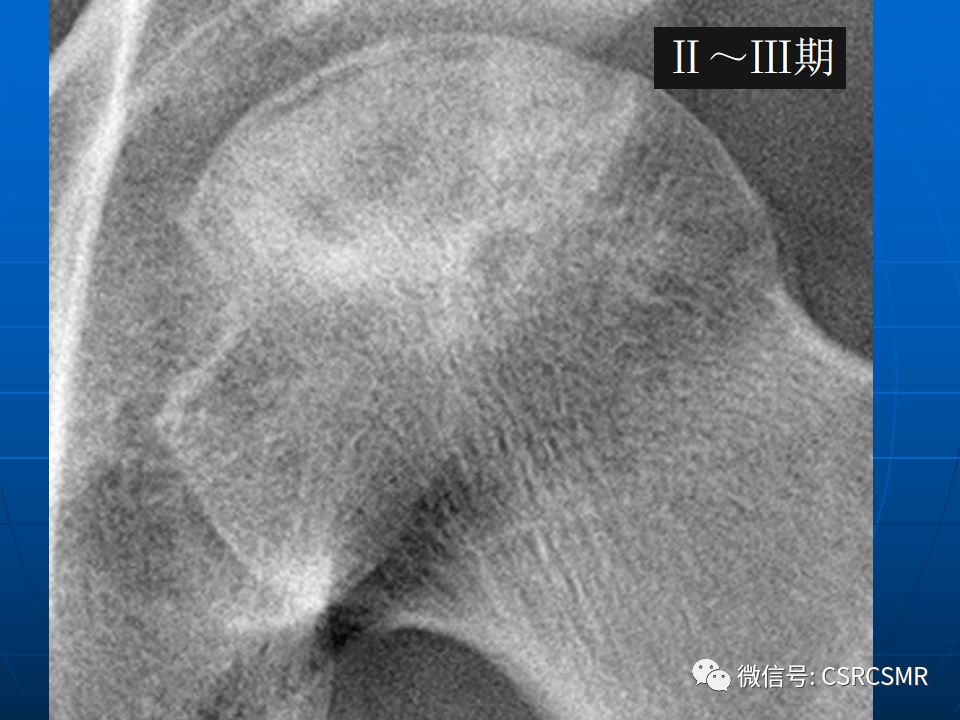 影像PPT - 【PPT】股骨头缺血坏死的大体标本、影像及病理-31