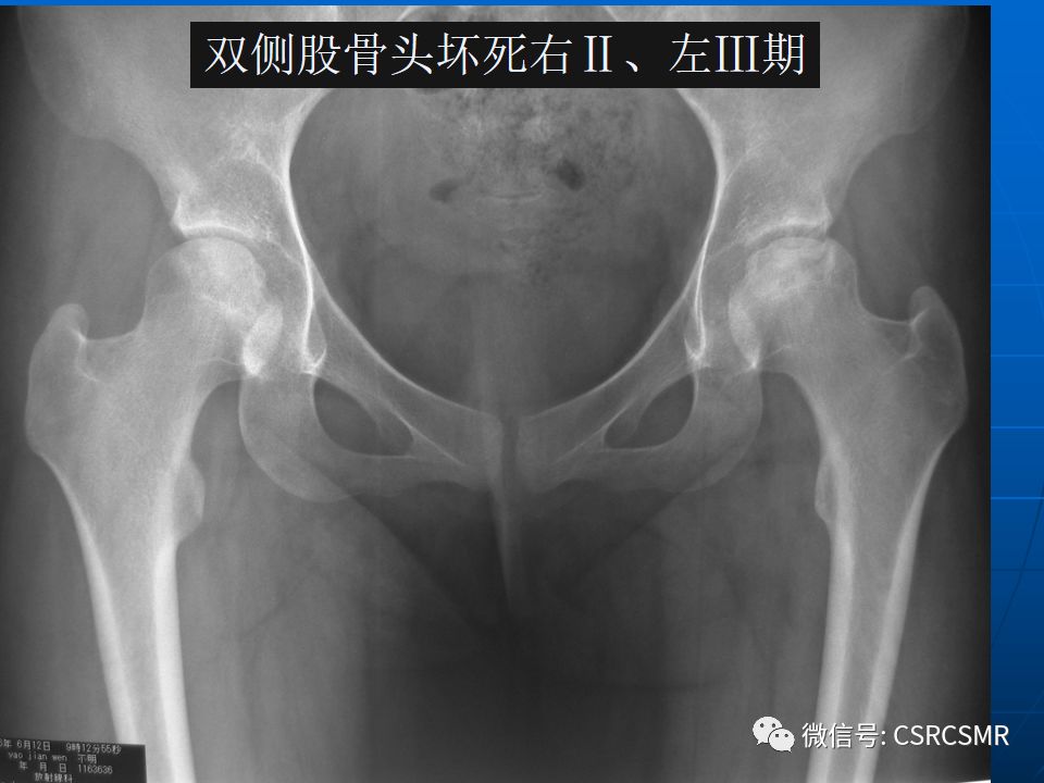 影像PPT - 【PPT】股骨头缺血坏死的大体标本、影像及病理-33