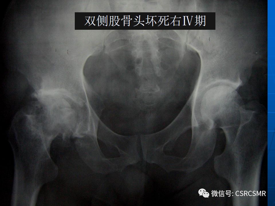 影像PPT - 【PPT】股骨头缺血坏死的大体标本、影像及病理-34