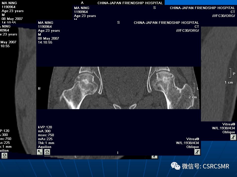 影像PPT - 【PPT】股骨头缺血坏死的大体标本、影像及病理-36