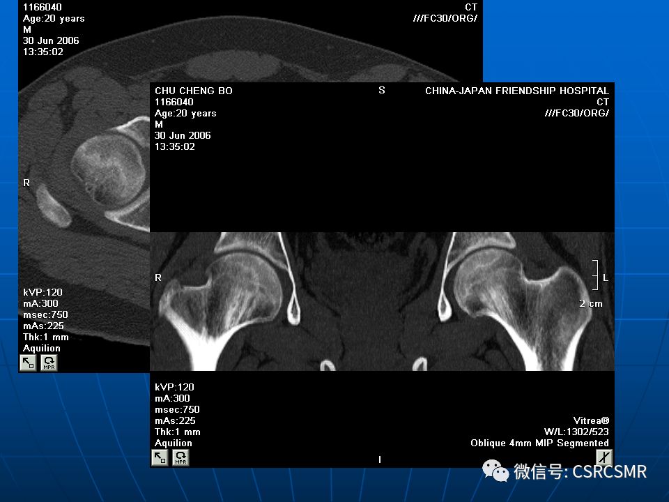 影像PPT - 【PPT】股骨头缺血坏死的大体标本、影像及病理-37
