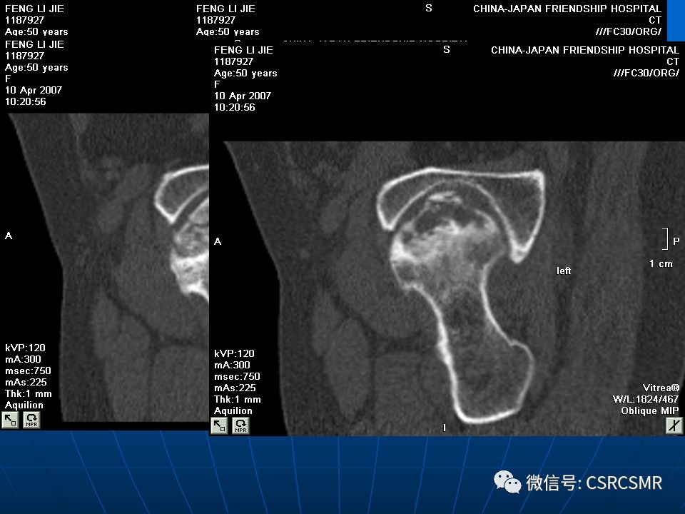 影像PPT - 【PPT】股骨头缺血坏死的大体标本、影像及病理-38