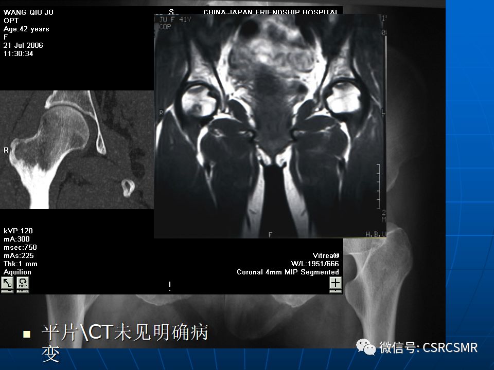影像PPT - 【PPT】股骨头缺血坏死的大体标本、影像及病理-39