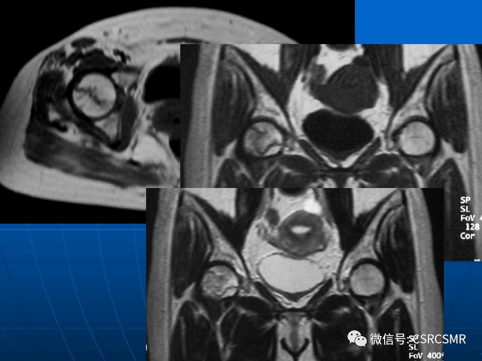 影像PPT - 【PPT】股骨头缺血坏死的大体标本、影像及病理-42