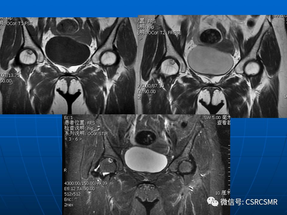 影像PPT - 【PPT】股骨头缺血坏死的大体标本、影像及病理-43