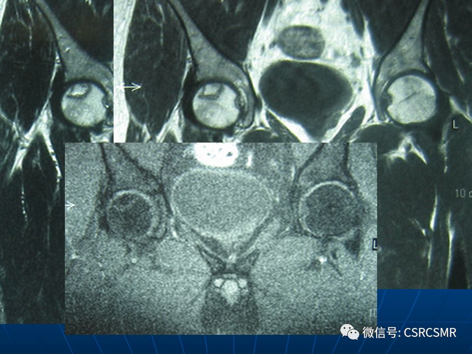 影像PPT - 【PPT】股骨头缺血坏死的大体标本、影像及病理-45