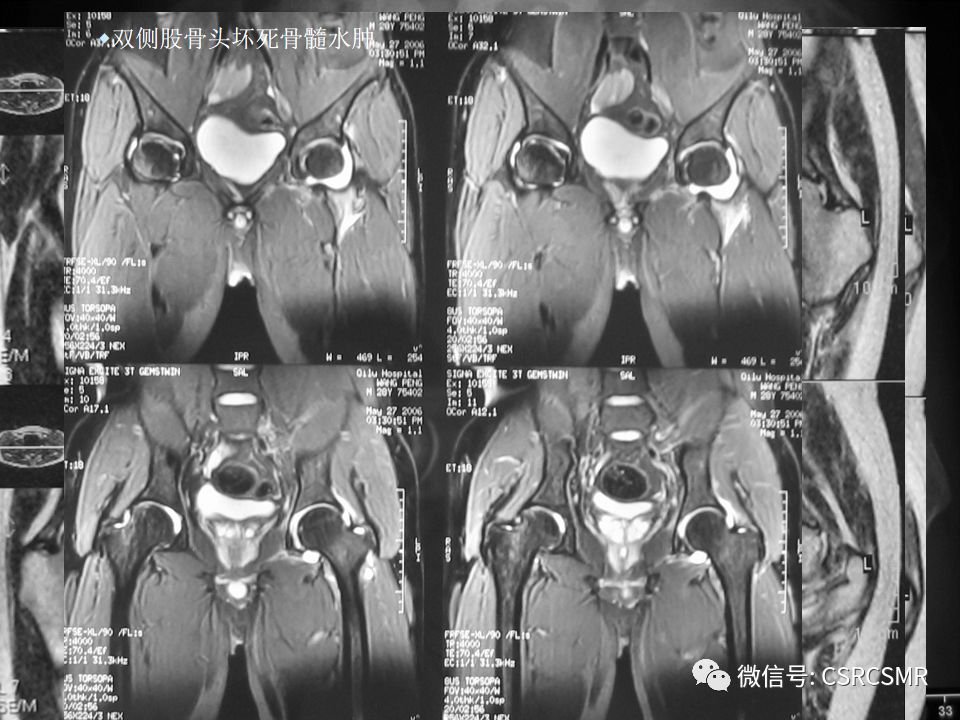 影像PPT - 【PPT】股骨头缺血坏死的大体标本、影像及病理-47