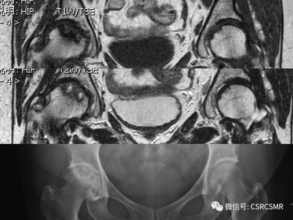 影像PPT - 【PPT】股骨头缺血坏死的大体标本、影像及病理-48