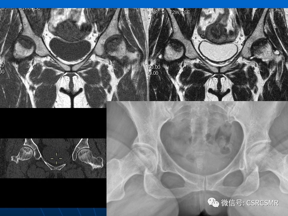 影像PPT - 【PPT】股骨头缺血坏死的大体标本、影像及病理-49