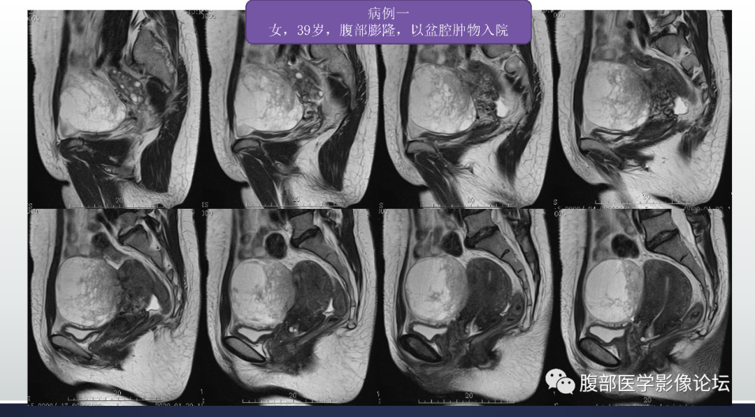 影像PPT - 【病例】子宫平滑肌瘤1例MR影像诊断-2