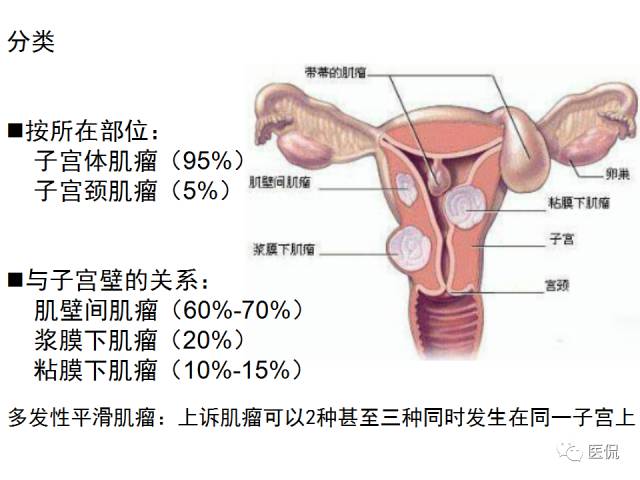 影像PPT - 【病例】子宫平滑肌瘤1例MR影像诊断-11