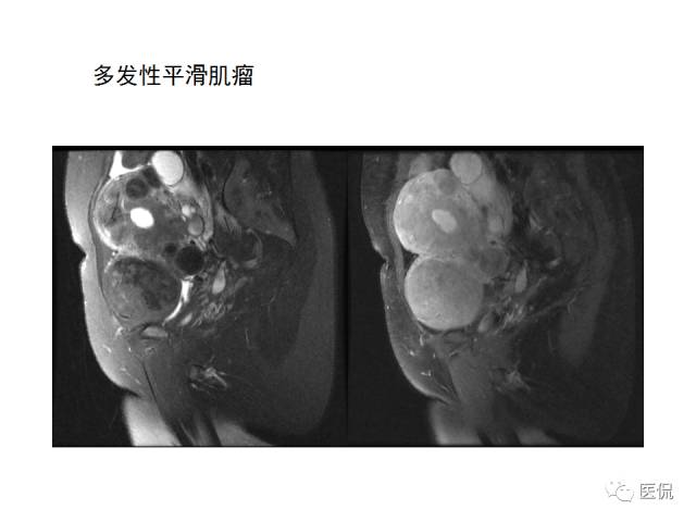 影像PPT - 【病例】子宫平滑肌瘤1例MR影像诊断-18