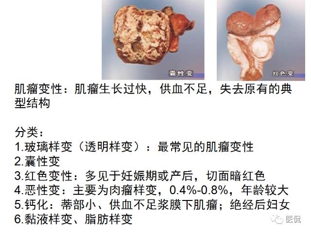 影像PPT - 【病例】子宫平滑肌瘤1例MR影像诊断-19