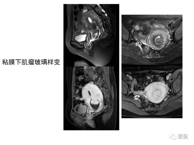 影像PPT - 【病例】子宫平滑肌瘤1例MR影像诊断-20