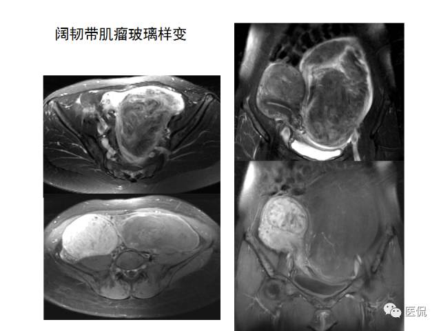 影像PPT - 【病例】子宫平滑肌瘤1例MR影像诊断-21