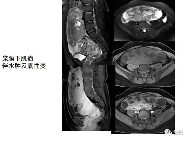 影像PPT - 【病例】子宫平滑肌瘤1例MR影像诊断-22