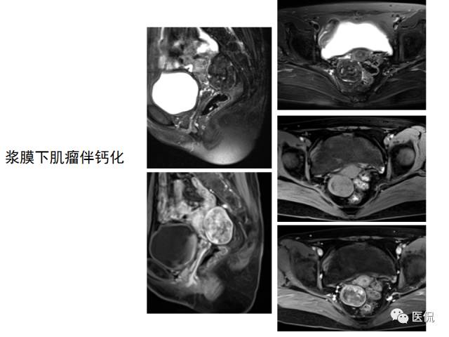 影像PPT - 【病例】子宫平滑肌瘤1例MR影像诊断-23