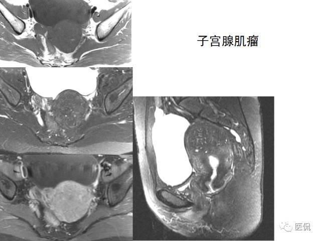 影像PPT - 【病例】子宫平滑肌瘤1例MR影像诊断-25