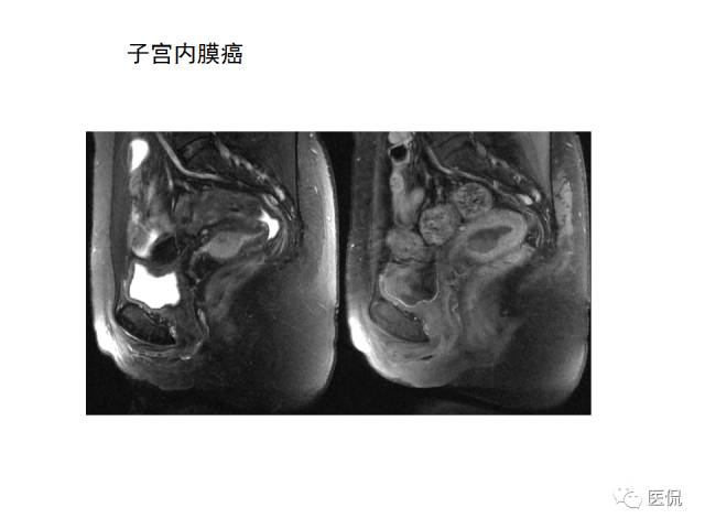 影像PPT - 【病例】子宫平滑肌瘤1例MR影像诊断-26
