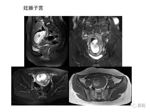 影像PPT - 【病例】子宫平滑肌瘤1例MR影像诊断-27