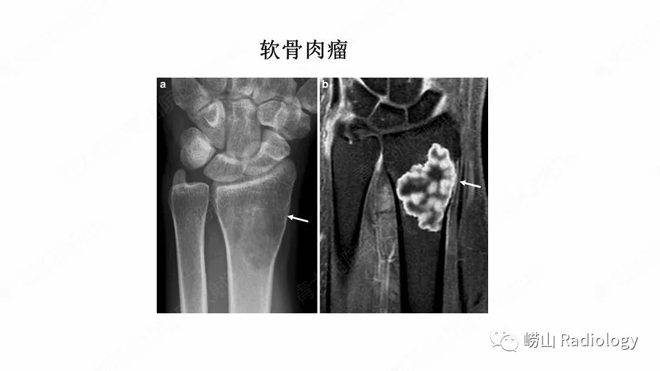 影像PPT - 【病例】鞍区软骨肉瘤1例CT及MR影像-15