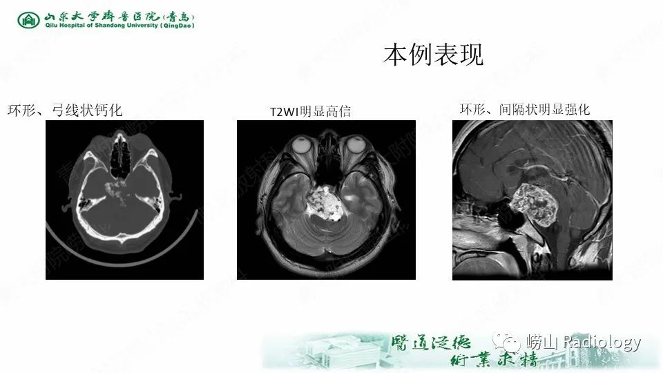 影像PPT - 【病例】鞍区软骨肉瘤1例CT及MR影像-16