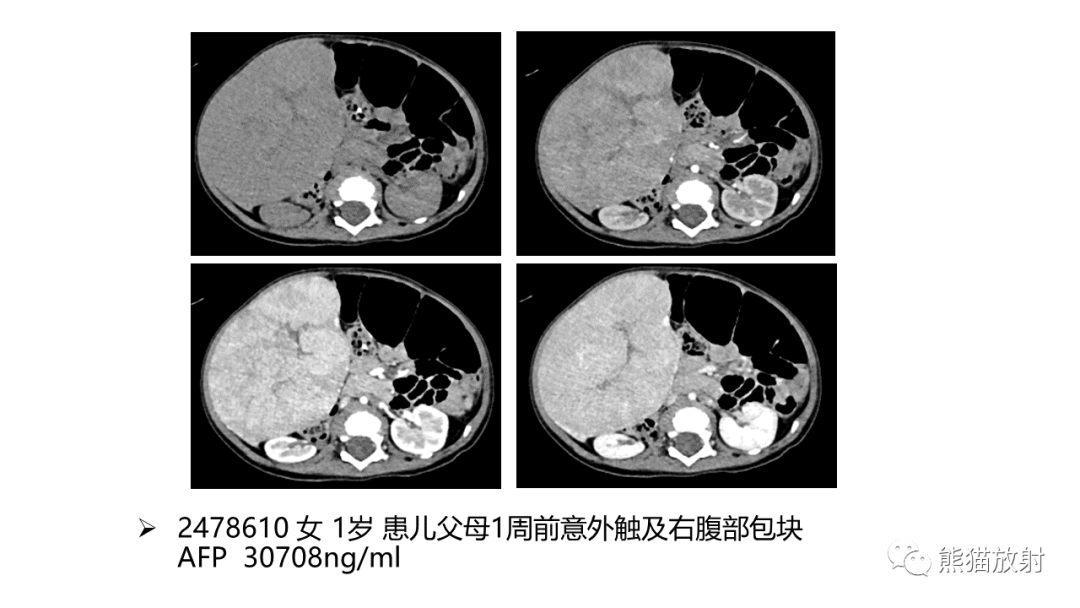 影像PPT - 【病例】肝母细胞瘤 VS FNH-38