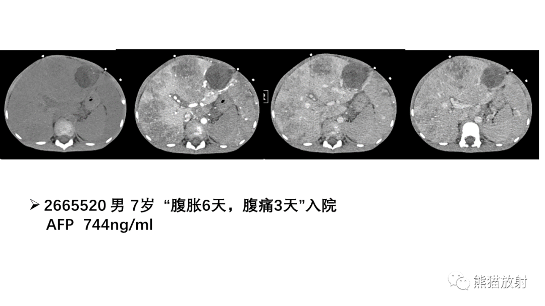影像PPT - 【病例】肝母细胞瘤 VS FNH-40
