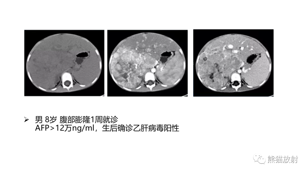 影像PPT - 【病例】肝母细胞瘤 VS FNH-42