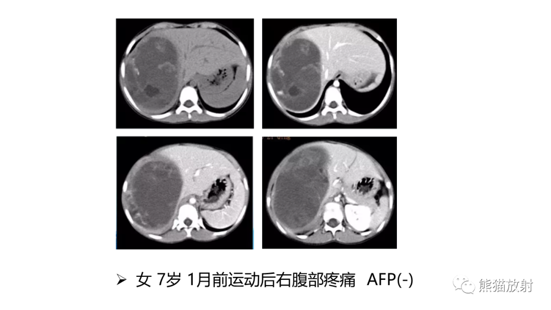 影像PPT - 【病例】肝母细胞瘤 VS FNH-47